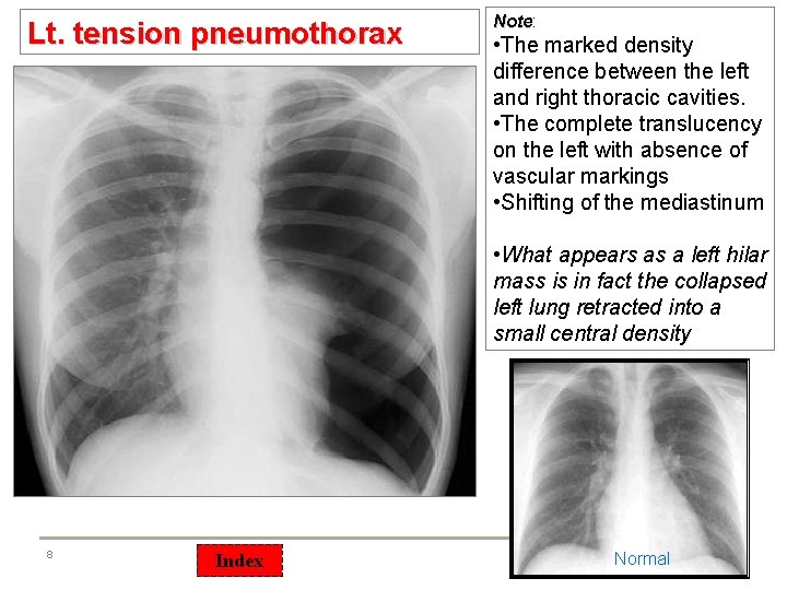 Lt. tension pneumothorax Note: Note • The marked density difference between the left and