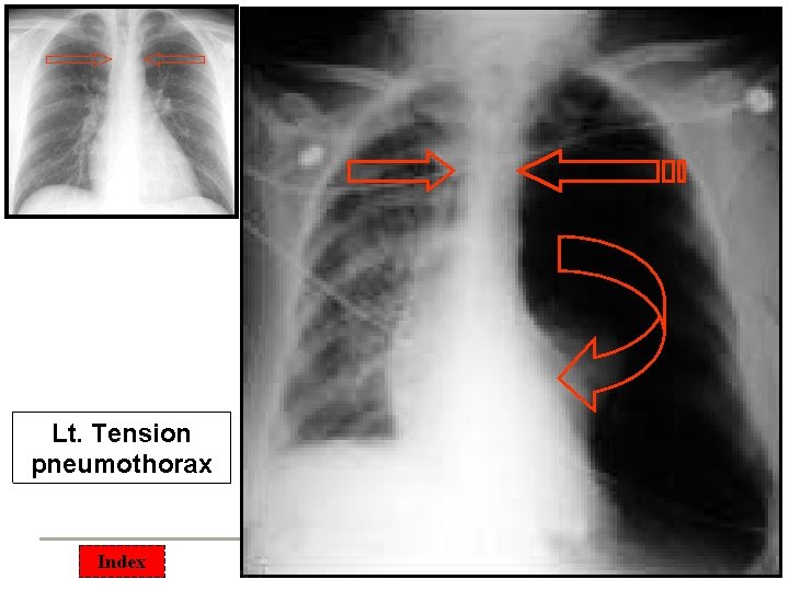 Lt. Tension pneumothorax Index 