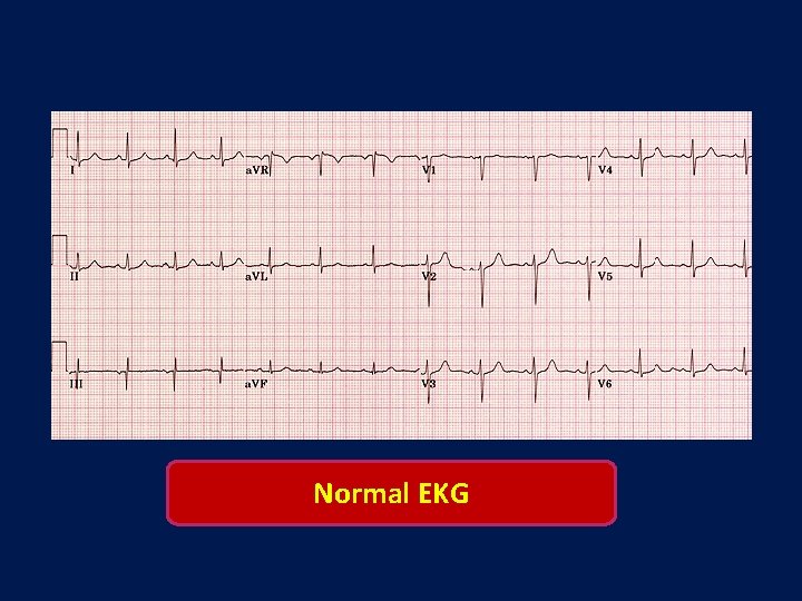 Normal EKG 