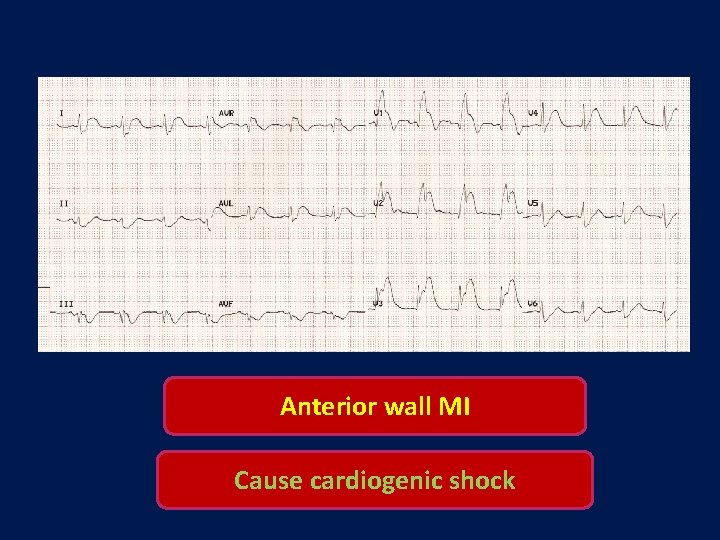 Anterior wall MI Cause cardiogenic shock 