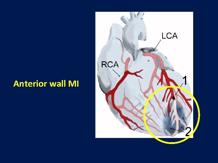 Anterior wall MI 