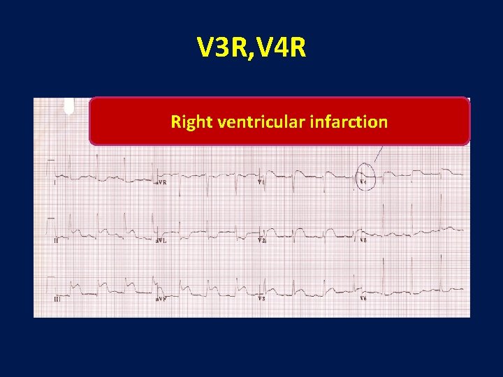 V 3 R, V 4 R Right ventricular infarction 