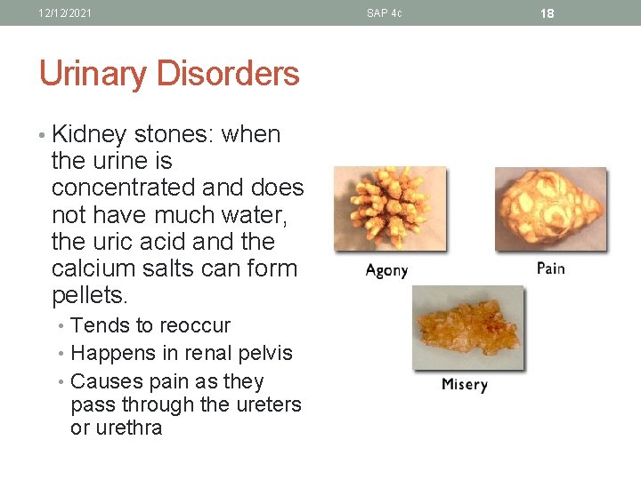 12/12/2021 Urinary Disorders • Kidney stones: when the urine is concentrated and does not