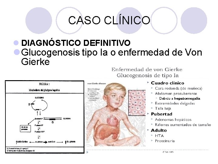 CASO CLÍNICO l DIAGNÓSTICO DEFINITIVO l Glucogenosis tipo Ia o enfermedad de Von Gierke