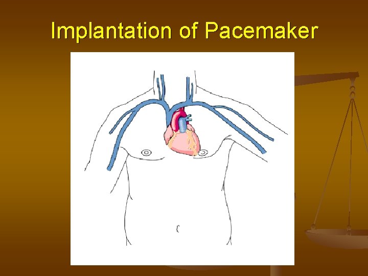 Implantation of Pacemaker 