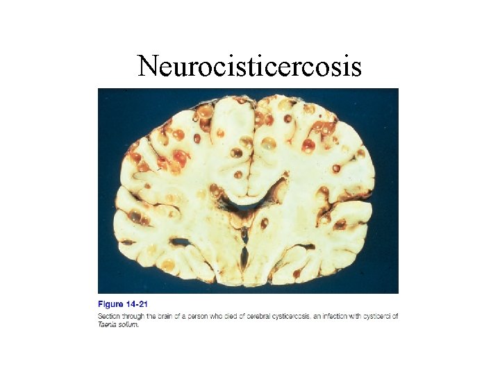 Neurocisticercosis 