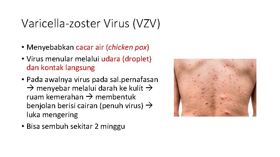 Varicella-zoster Virus (VZV) • Menyebabkan cacar air (chicken pox) • Virus menular melalui udara