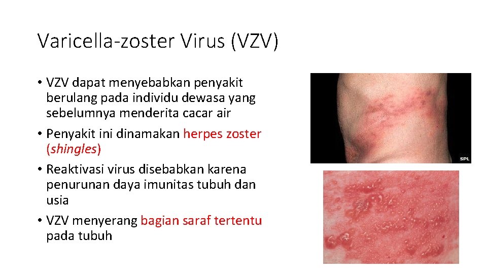 Varicella-zoster Virus (VZV) • VZV dapat menyebabkan penyakit berulang pada individu dewasa yang sebelumnya