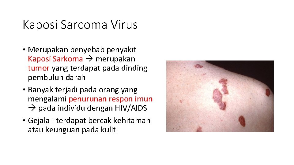 Kaposi Sarcoma Virus • Merupakan penyebab penyakit Kaposi Sarkoma merupakan tumor yang terdapat pada