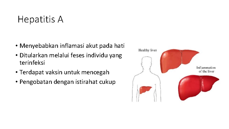 Hepatitis A • Menyebabkan inflamasi akut pada hati • Ditularkan melalui feses individu yang