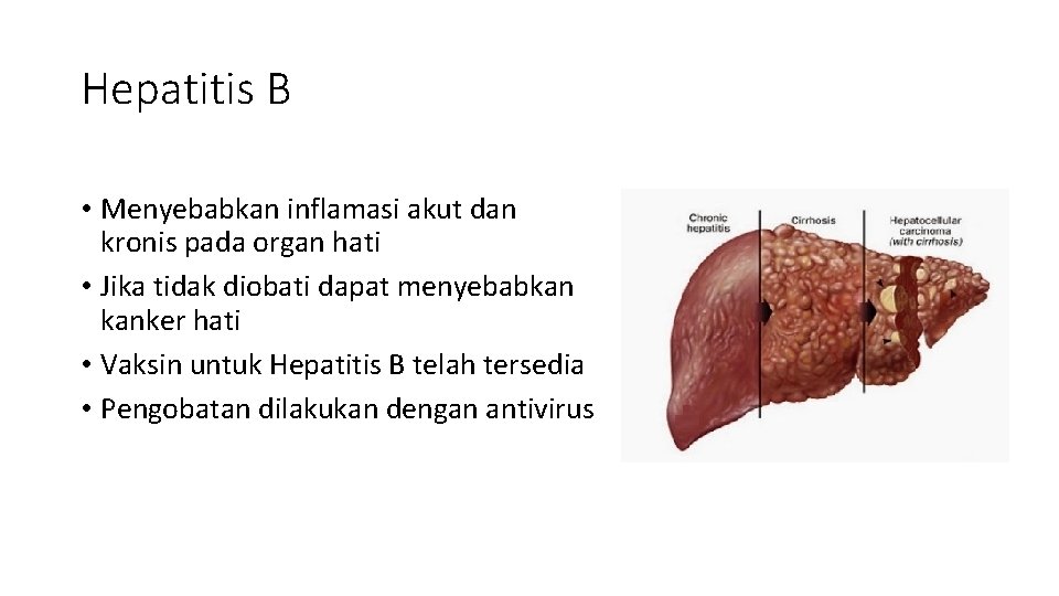 Hepatitis B • Menyebabkan inflamasi akut dan kronis pada organ hati • Jika tidak