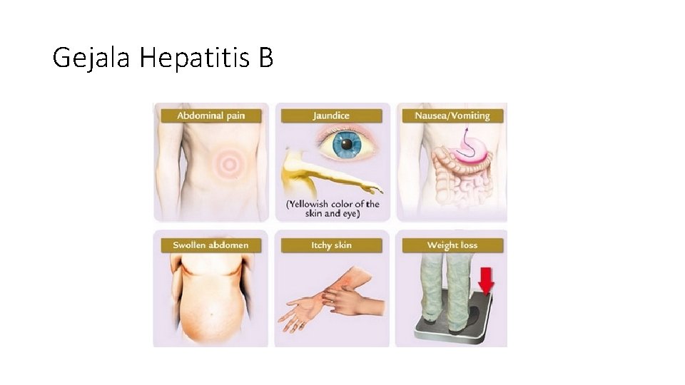 Gejala Hepatitis B 