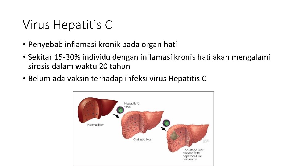 Virus Hepatitis C • Penyebab inflamasi kronik pada organ hati • Sekitar 15 -30%