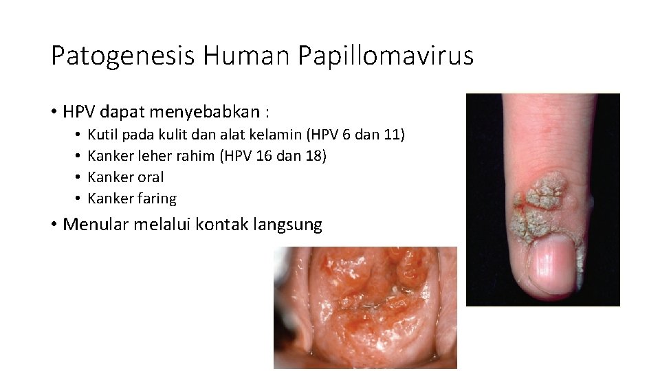 Patogenesis Human Papillomavirus • HPV dapat menyebabkan : • • Kutil pada kulit dan
