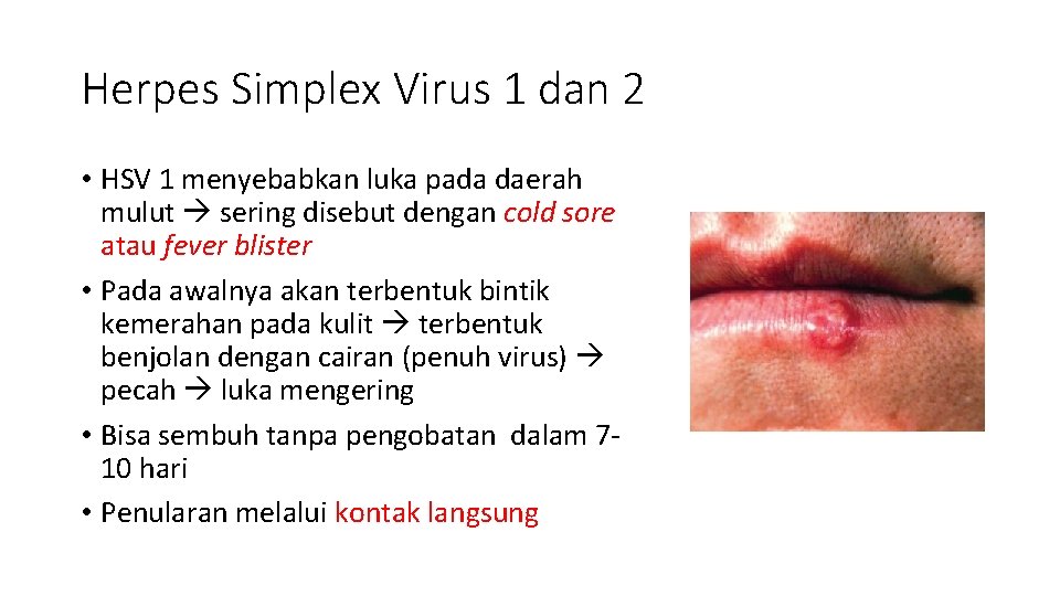 Herpes Simplex Virus 1 dan 2 • HSV 1 menyebabkan luka pada daerah mulut