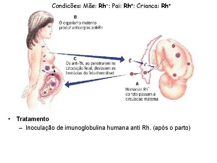 Condições: Mãe: Rh-; Pai: Rh+; Criança: Rh+ • Tratamento – Inoculação de imunoglobulina humana