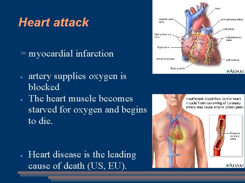 Heart attack = myocardial infarction artery supplies oxygen is blocked The heart muscle becomes