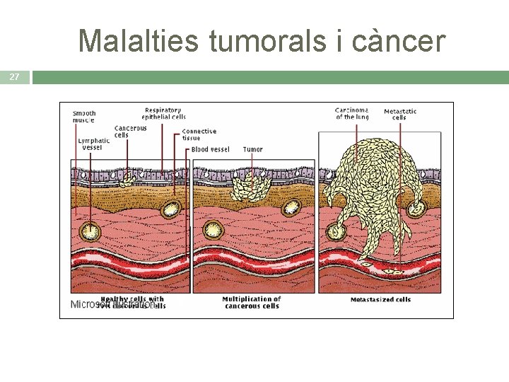 Malalties tumorals i càncer 27 