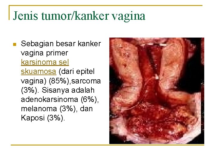 Jenis tumor/kanker vagina n Sebagian besar kanker vagina primer karsinoma sel skuamosa (dari epitel