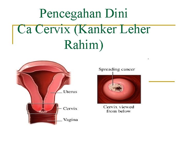 Pencegahan Dini Ca Cervix (Kanker Leher Rahim) 