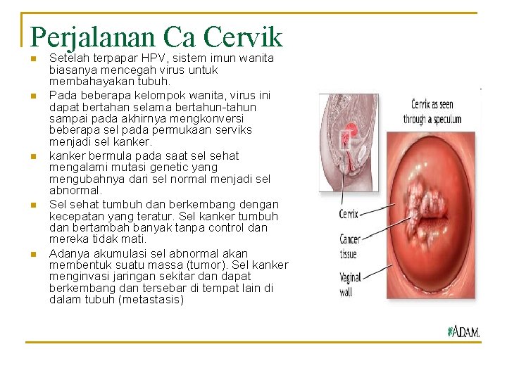 Perjalanan Ca Cervik n n n Setelah terpapar HPV, sistem imun wanita biasanya mencegah