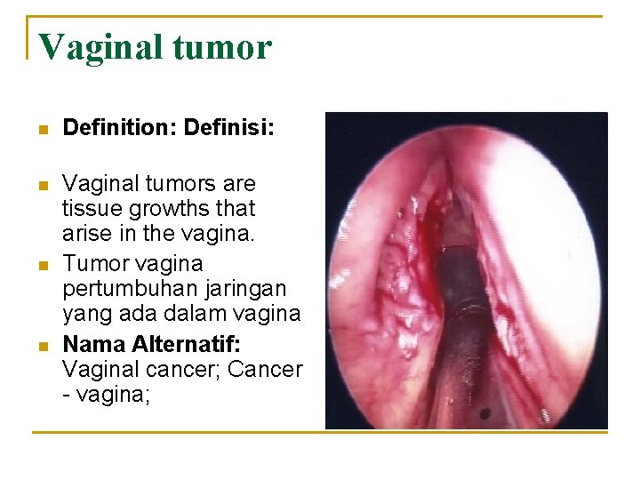 Vaginal tumor n Definition: Definisi: n Vaginal tumors are tissue growths that arise in