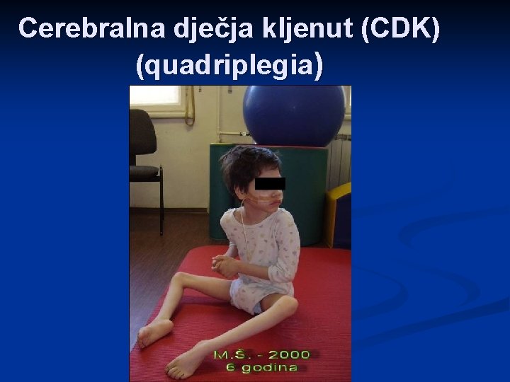 Cerebralna dječja kljenut (CDK) (quadriplegia) 