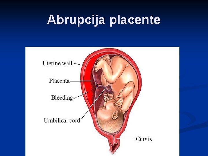 Abrupcija placente 