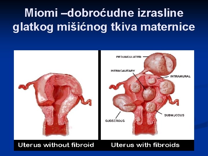 Miomi –dobroćudne izrasline glatkog mišićnog tkiva maternice 