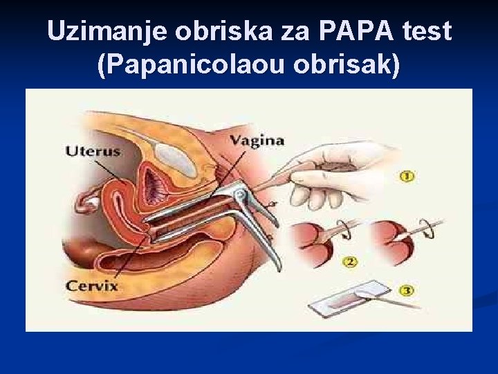 Uzimanje obriska za PAPA test (Papanicolaou obrisak) 