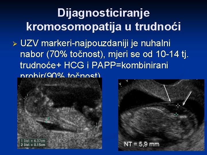 Dijagnosticiranje kromosomopatija u trudnoći Ø UZV markeri-najpouzdaniji je nuhalni nabor (70% točnost), mjeri se