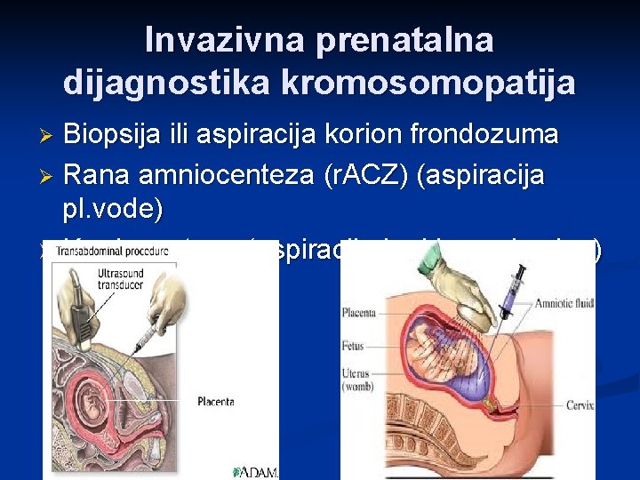 Invazivna prenatalna dijagnostika kromosomopatija Biopsija ili aspiracija korion frondozuma Ø Rana amniocenteza (r. ACZ)