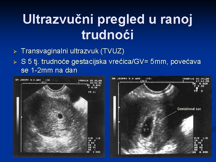 Ultrazvučni pregled u ranoj trudnoći Ø Ø Transvaginalni ultrazvuk (TVUZ) S 5 tj. trudnoće