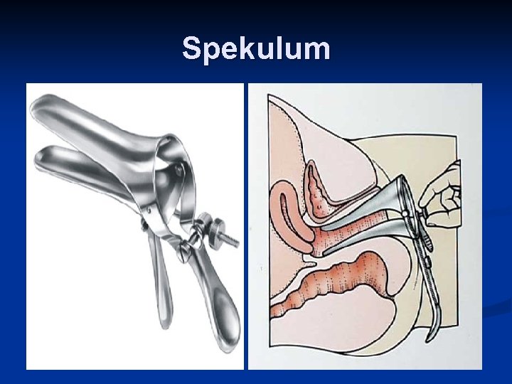 Spekulum 