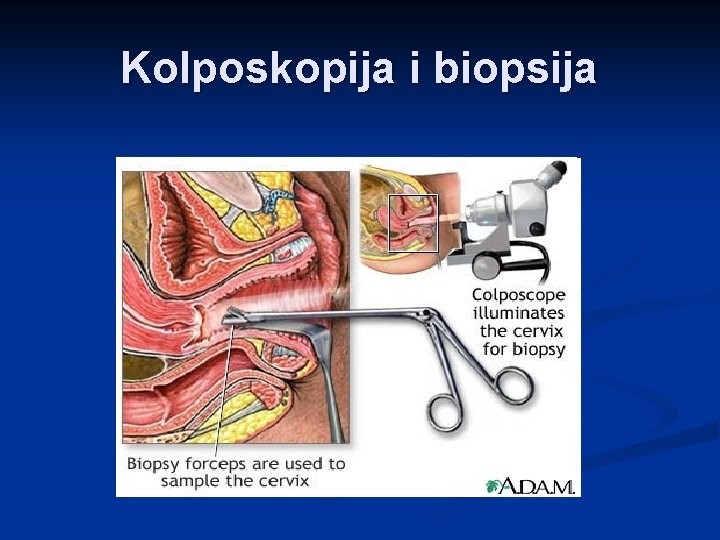 Kolposkopija i biopsija 