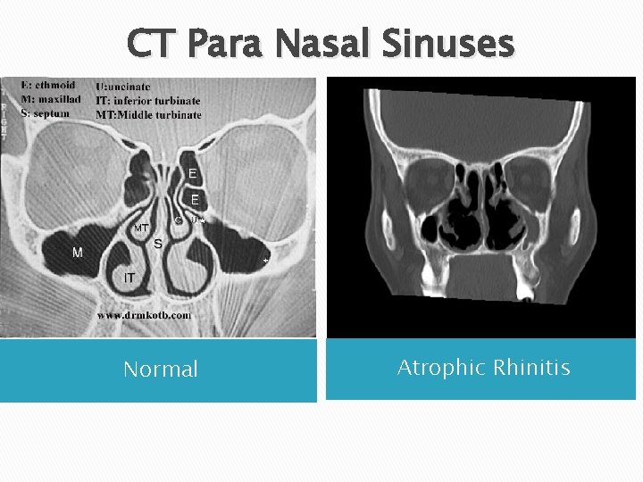 CT Para Nasal Sinuses Normal Atrophic Rhinitis 