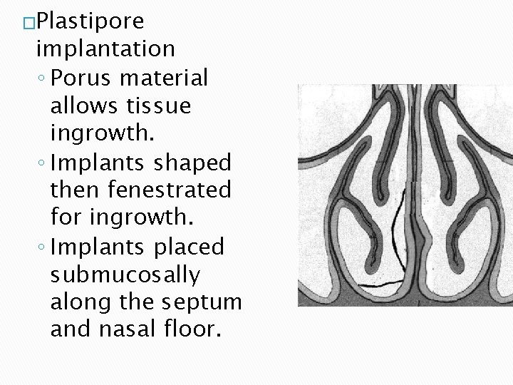 �Plastipore implantation ◦ Porus material allows tissue ingrowth. ◦ Implants shaped then fenestrated for