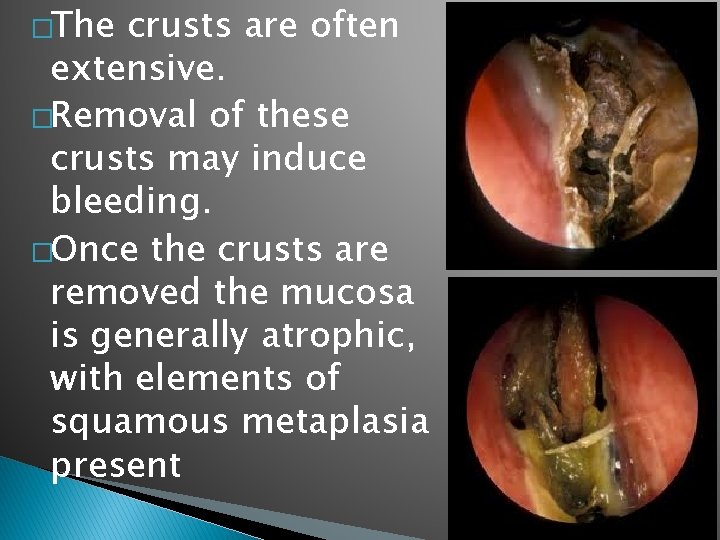 �The crusts are often extensive. �Removal of these crusts may induce bleeding. �Once the