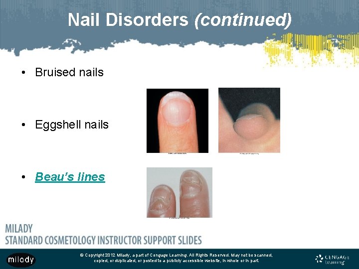 Nail Disorders (continued) • Bruised nails • Eggshell nails • Beau’s lines © Copyright