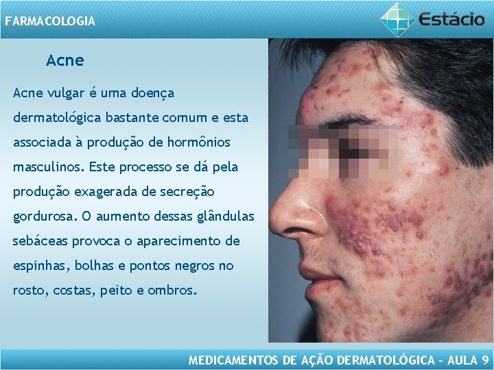 FARMACOLOGIA Acne vulgar é uma doença dermatológica bastante comum e esta associada à produção