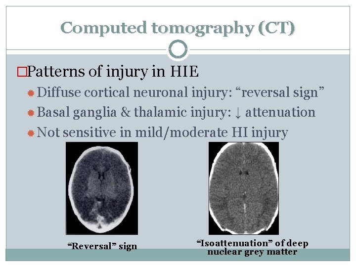 Computed tomography (CT) �Patterns of injury in HIE Diffuse cortical neuronal injury: “reversal sign”