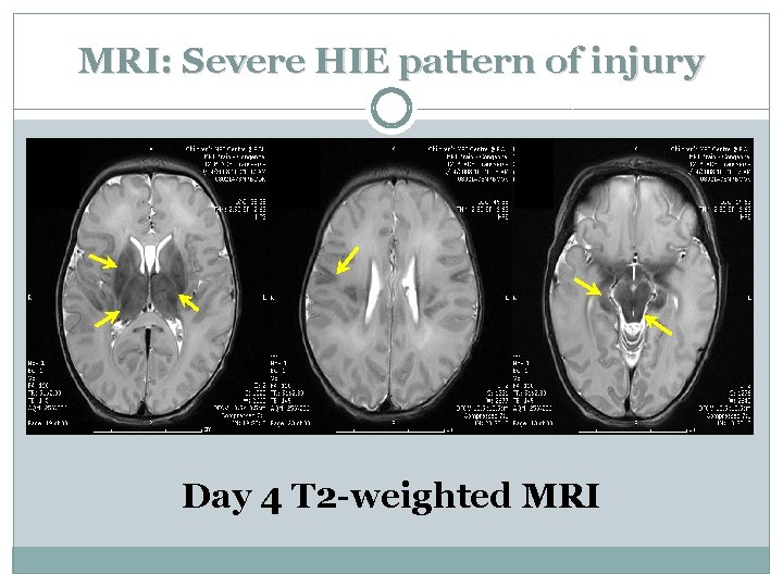 MRI: Severe HIE pattern of injury Day 4 T 2 -weighted MRI 