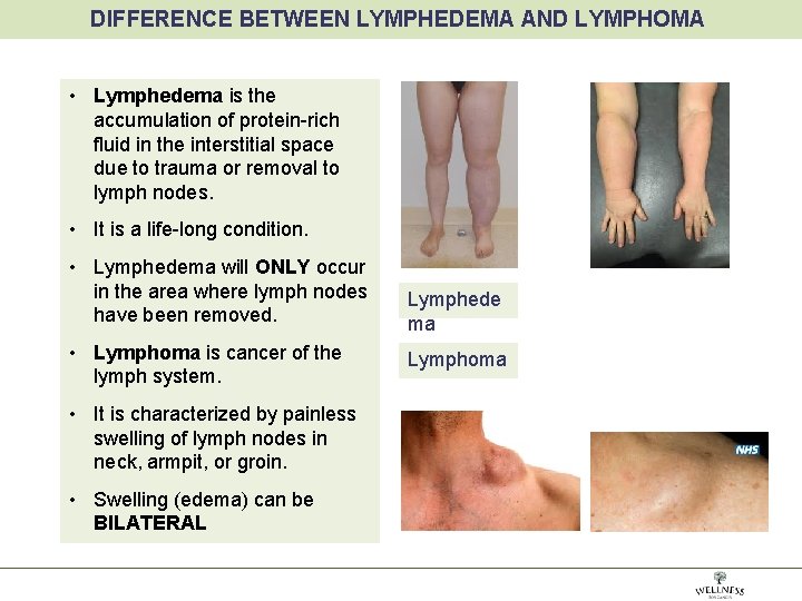 DIFFERENCE BETWEEN LYMPHEDEMA AND LYMPHOMA • Lymphedema is the accumulation of protein-rich fluid in