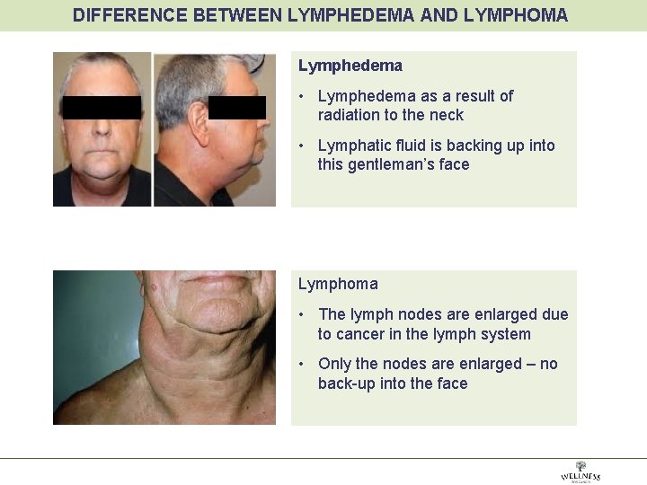 DIFFERENCE BETWEEN LYMPHEDEMA AND LYMPHOMA Lymphedema • Lymphedema as a result of radiation to