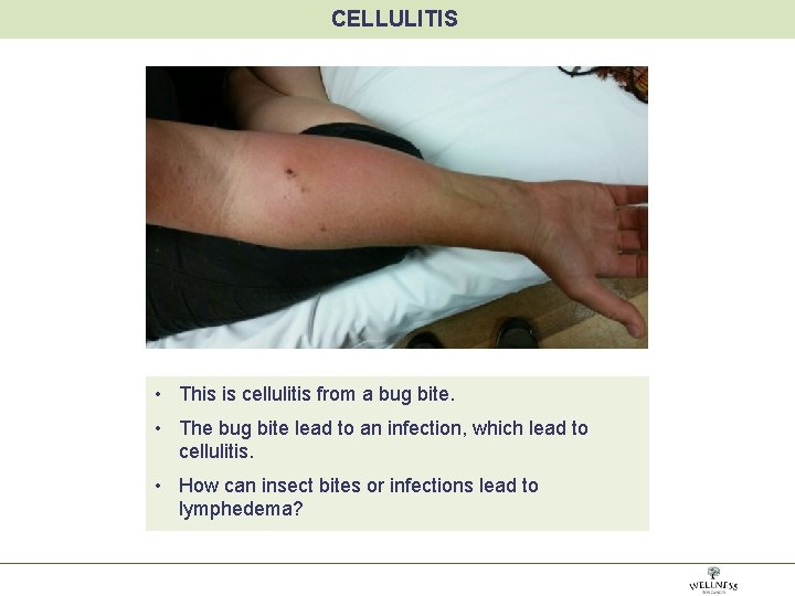 CELLULITIS • This is cellulitis from a bug bite. • The bug bite lead