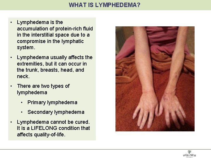 WHAT IS LYMPHEDEMA? • Lymphedema is the accumulation of protein-rich fluid in the interstitial