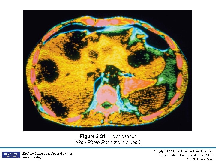 Figure 3 -21 Liver cancer (Gca/Photo Researchers, Inc. ) Medical Language, Second Edition Susan