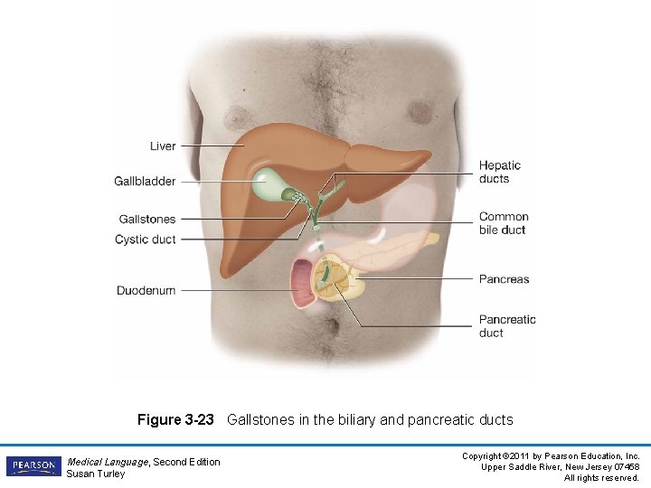 Figure 3 -23 Gallstones in the biliary and pancreatic ducts Medical Language, Second Edition