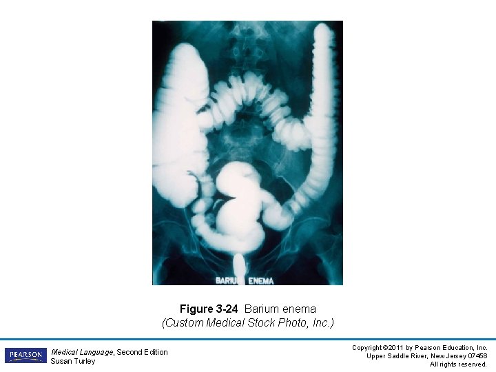 Figure 3 -24 Barium enema (Custom Medical Stock Photo, Inc. ) Medical Language, Second