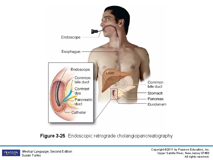 Figure 3 -25 Endoscopic retrograde cholangiopancreatography Medical Language, Second Edition Susan Turley Copyright ©